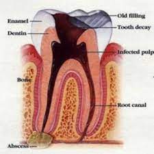 5 Different Types Of Teeth Problems Tooth Infection Dental Infection Root Canal