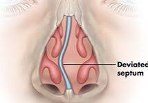 Why does my nose get more stopped up at night? Nasal Congestion Stuffy Nose Texas Sinus Snoring Houston Tx