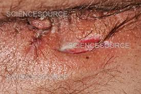 Image result for Perianal Abscess