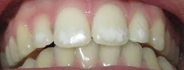 Hyperfluorose Weisse Flecken Bleaching Denta Beaute