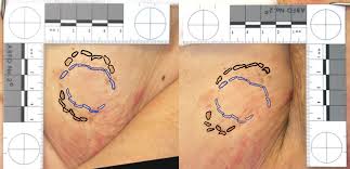 .loc o eclipsă parţială de soare şi soarele va fi acoperit doar în parte de discul lunii. Changes In Bitemark Appearance Depending Upon How The Body Part Is Download Scientific Diagram
