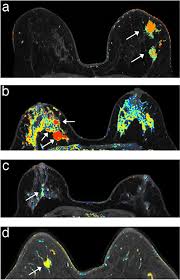 It is often done in women who have already been diagnosed with breast cancer to measure size and. For Women With Genetic Risk Twice A Year Mri Beats Mammograms Eurekalert Science News