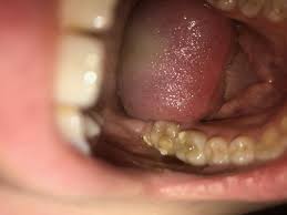 Image result for Alveolitis sicca)