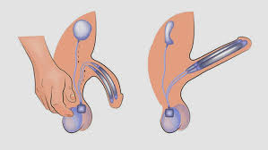 Image result for Penile Prosthesis
