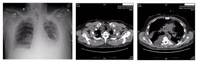 Some cases of the disorder result from common ailments like arthritis, bacterial infections. Right Lung Cavity With Bilateral Pleural Effusions Sgim Org