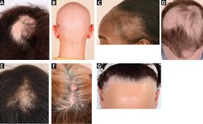 Does scalp tension cause hair loss? Male And Female Pattern Hair Loss Treatable And Worth Treating Cleveland Clinic Journal Of Medicine