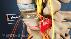 Que Es Una Hernia De Disco Un Pinzamiento De Un Nervio Un Disco Protuberante