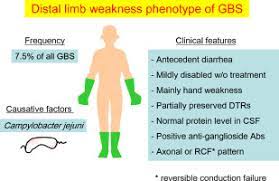 Typically, both sides of the body are involved, and the initial symptoms are changes in sensation or pain often in the back along with muscle weakness. Distal Limb Weakness Phenotype Of Guillain Barre Syndrome Sciencedirect