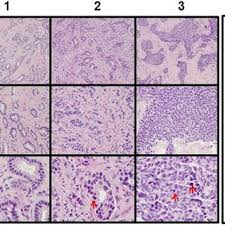 .engineering in nottingham malaysia campus or ukm (national university of malaysia)? Invasive Ductal Carcinoma Of Various Nottingham Histological Grades Download Scientific Diagram