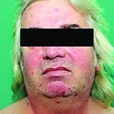 Maybe you would like to learn more about one of these? Secondary Syphilis Red To Purple Papules And Nodules Located On The Face Download Scientific Diagram