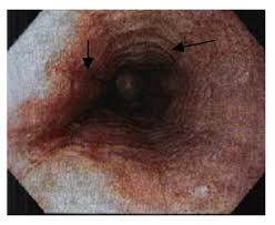 Large ulcers (red, black and white arrows) are seen in these two views of the distal esophagus from. Diagnostic Endoscopy Intechopen