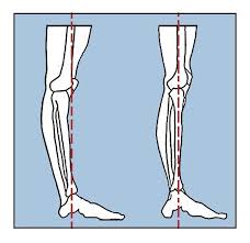 It is also referred to as genu recurvatum or having banana knees. Rausch Physical Therapy Sports Performance Knee Hyperextension In Dancers