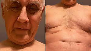 UK dad becomes world's longest-surviving triple heart bypass patient