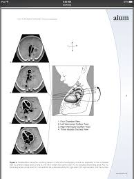 Aium Heart Images Obstetric Ultrasound Medical Ultrasound Ultrasound Technician