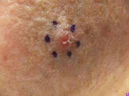 Because basal cell carcinomas and squamous cell carcinomas rarely spread beyond the skin, a biopsy and microscopic examination often is the only test needed. Disease Management Nonmelanoma Skin Cancer