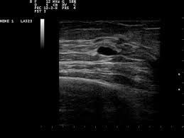 Breast cysts are benign sacs of fluid which present as small, firm lumps in the breast tissue. Breast Cyst Wikipedia