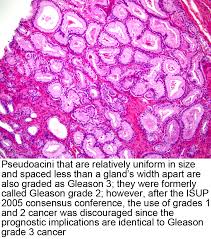 Pathology Outlines Grading Gleason