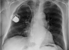 Herr philipp wimmer | letzte aktualisierung: Herzschrittmacher Medizinische Klinik Mit Schwerpunkt Kardiologie Und Angiologie Charite Universitatsmedizin Berlin