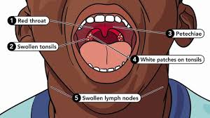 Image result for chlamydia symptoms