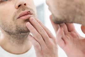 Touching a lesion and then touching your lips. Herpes Simplex Symptoms Pictures Types Treatment