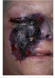 Mucormicosis rinocerebral en paciente con cefalea y diabetes mellitus. Figure 10 From Mucormycosis Of The Head And Neck Semantic Scholar