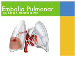 A pesar de que la tvp se desarrolla con mayor frecuencia en las piernas, las venas profundas de los brazos, esplácnicas y cerebrales también pueden estar afectadas. Embolia Pulmonar