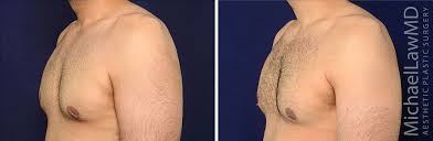 Crater Deformity Correction Gynecomastia Surgery Revision Photo Gallery Gynecomastia Gynecomastia Surgery Surgery