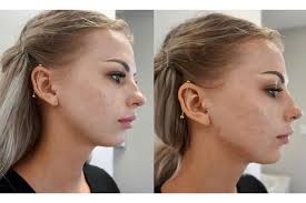12 months or even longer, depending on the filler used. Jawline Contouring Dublin Jawline Filler Facial Rejuve