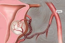 It uses sound waves to get a picture of the uterus to fibroids are not cancerous, and they very rarely interfere with pregnancy. A Visual Guide To Uterine Fibroids