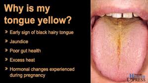 Image result for yellow tongue infection