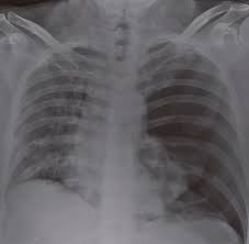 Pneumothorax is defined as air that has entered the pleural space, either spontaneously or as a result of traumatic tears in the pleura after chest injury or . Scielo Brasil Pneumothorax As A Late Complication Of Covid 19 Pneumothorax As A Late Complication Of Covid 19