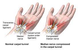These symptoms may or may not. Carpal Tunnel Syndrome Johns Hopkins Medicine