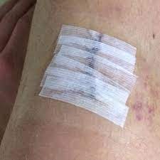 Wie Lange Pflaster Auf Naht Lassen Medizin Operation