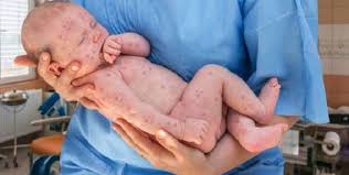 खसर ह न क क रण लक षण और इसक ल ए ट क करण Measles Meaning In Hindi