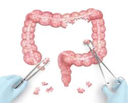 La maladie de crohn c'est quoi. La Maladie De Crohn Une Nouvelle Approche
