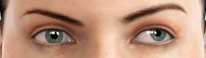 Image result for Strabismus