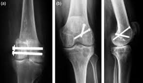 For medial epicondyle fractures, nonoperative management of fractures displaced up to 15 mm does not appear to be associated with functional a fall on the point of the elbow (apex of the flexed elbow), with the olecranon driving the medial condyle proximally and medially (see the second image below). Unicondylar Fractures Of The Distal Femur Sciencedirect