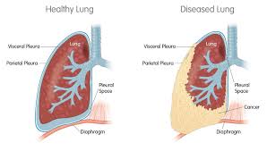 This form of mesothelioma appears as a grayish tumor that settles on the pleural surfaces that cover the lung and line the inner surface of the chest wall. Mesothelioma Bristol Medical School Translational Health Sciences University Of Bristol