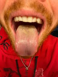 Image result for yellow tongue infection