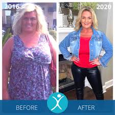 If you haven't decided to have surgery in turkey yet, ask your doctor for gastric sleeve before and after pictures and videos. Gastric Sleeve Before And After Photos The Best Pictures Of 2020