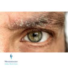 Image result for Seborrheic Dermatitis