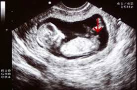Find out what happens at your 1st nhs ultrasound pregnancy scan, why it's called a dating scan and whether you find out your baby's sex. 7 Week Dating Scan Accuracy Url To