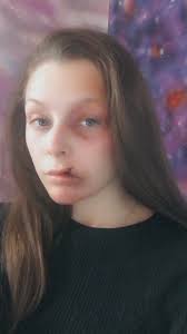 Stagehand injury makeup solution needed