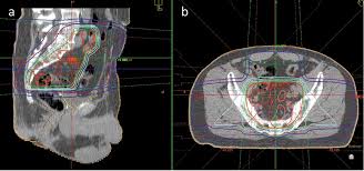 Hi everyone, my father (65 years old) was diagnosed with a prostate cancer on sept 2017, his psa was 400 then,gleason 4+4, mri showed that the cancer spread outside the prostate to the adjacent lymph nodes (2 or 3 tops) but bone scan and ct were otherwise normal. 68ga Psma Ligand Pet Ct Based Radiotherapy For Lymph Node Relapse Of Prostate Cancer After Primary Therapy Delays Initiation Of Systemic Therapy Anticancer Research