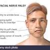 Bell's palsy is a weakness (paralysis) that affects the nerve fibres that control the muscles of the face. Https Encrypted Tbn0 Gstatic Com Images Q Tbn And9gctbctr5ggydmuakjp1dh20feenwg1 5h1z7mkqmawz6qepzotp4 Usqp Cau