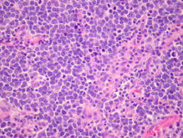 We are physicians and researchers who have cared for over 800 patients with mcc, a rare and aggressive skin cancer. Merkel Cell Carcinoma Pathology Dermnet Nz
