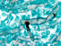 Black fungus has historically been extremely rare, affecting 900,000 people per year, which is less than 1% of the population, in india a year, according to a study published in 2017. What Diabetics Should Know About Black Fungus In India S Covid Patients