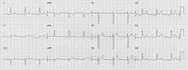 Laurence hunter project development manager: Ecg Ekg Examples And Quiz Oxford Medical Education