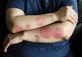 Image result for psoriasis