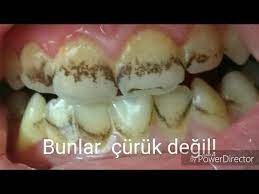 Diş temizleme operasyonunun zararı yoktur. Dis Lekeleri Nasil Giderilir Renkli Tukuruk Youtube